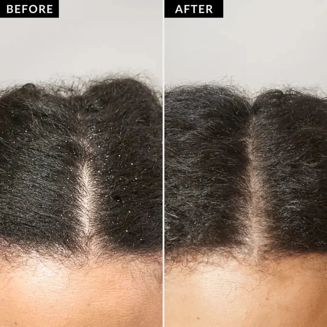 Peigne Détox Deravea™ – Élimine sébum, pellicules et résidus